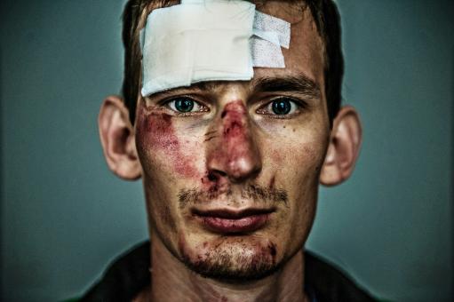 How Common are Cycling Head Injuries?